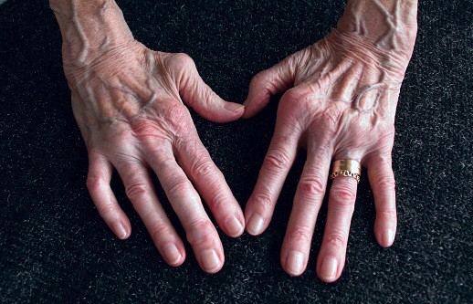 Can CBD Oil Treat Rheumatoid Arthritis Symptoms?