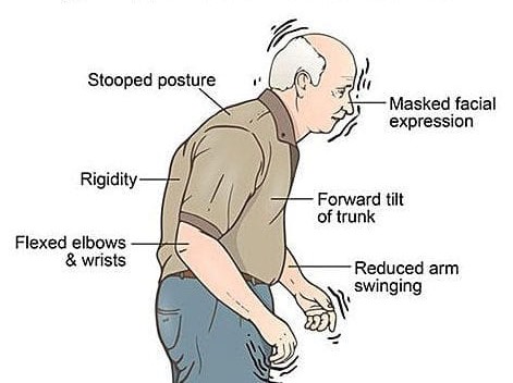 signs Parkinson Disease